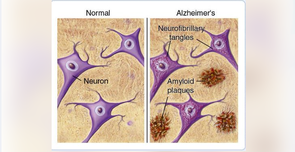Amyloid Reduction Support
